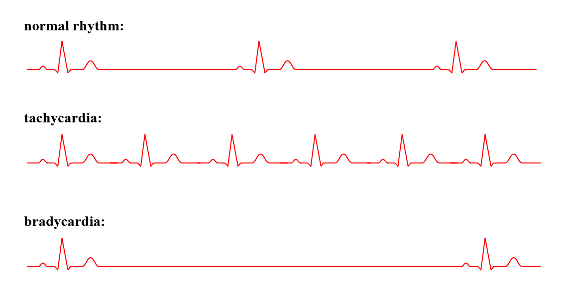 Different rhythms in the heart (tachy- and bradycardia)